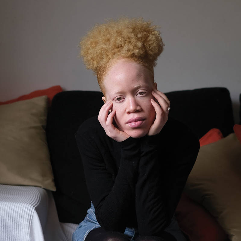 O albinismo, pela lente da fotógrafa Mag Rodrigues