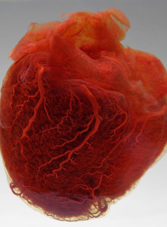 As partículas de microplásticos foram pela primeira vez associadas à doença cardíaca